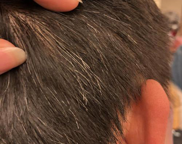 什么是營(yíng)養(yǎng)性灰白發(fā)？