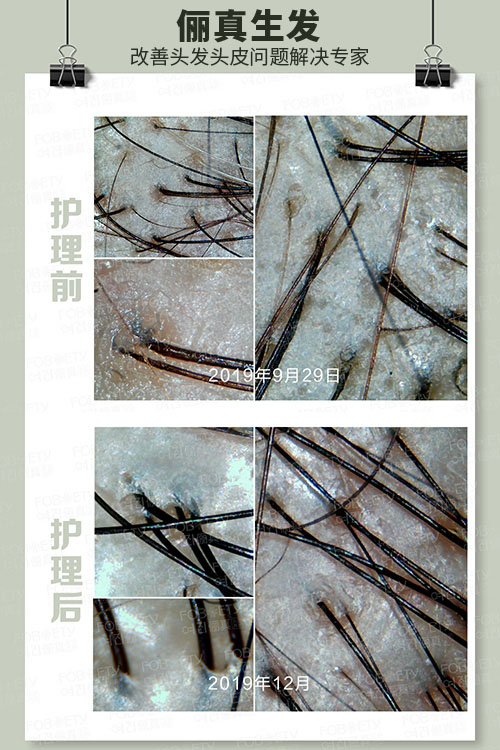 頭油、頭癢